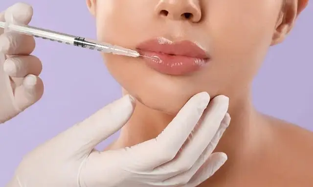 lip filler injections in a cosmetic surgery practice